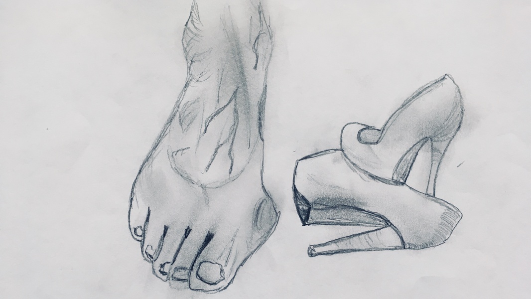 Вальгусная деформация I пальца стопы